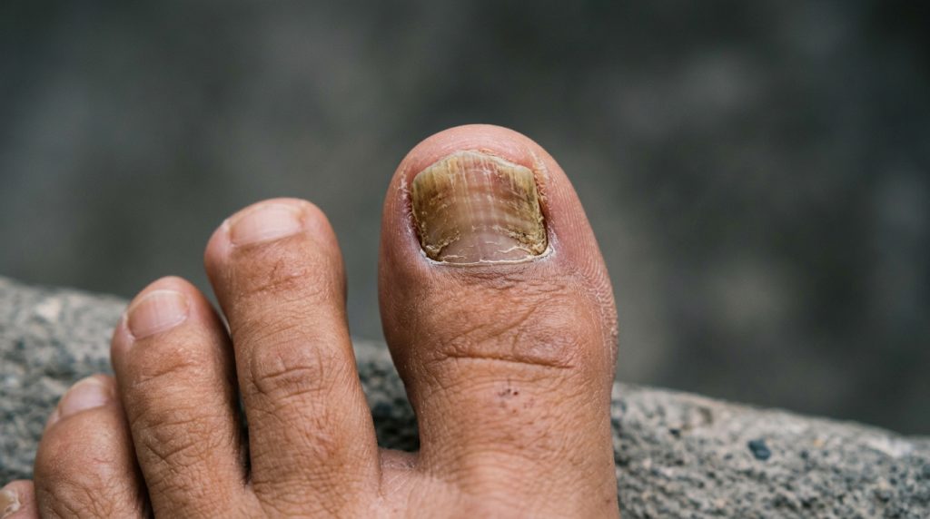 Hongos en las uñas de los pies: cómo tratar la onicomicosis según la gravedad